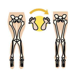 O脚・X脚にも鍼灸を